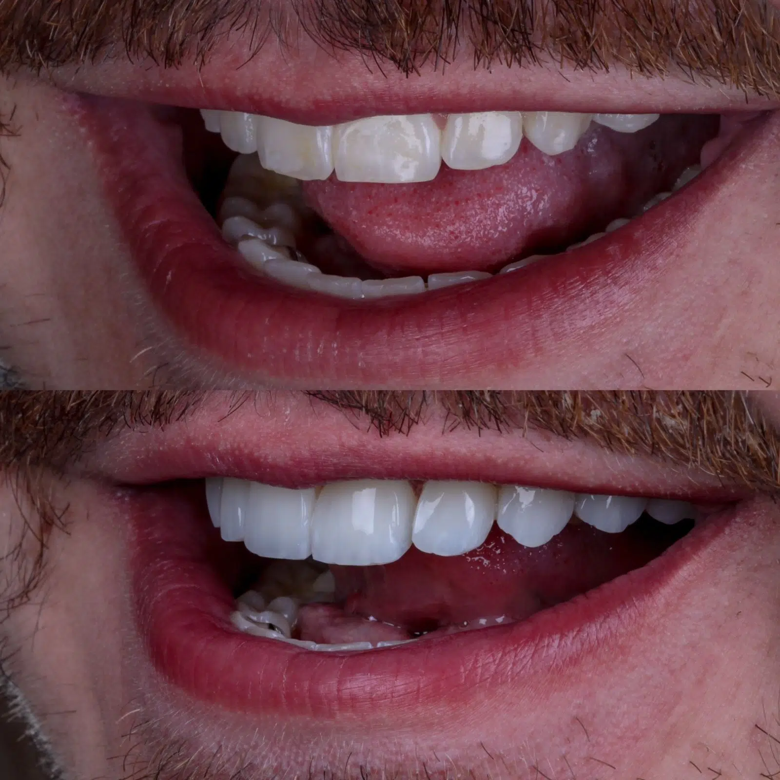 Resultados - Lentes em resina 2